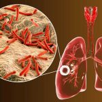 بیماری سل چیست و چه علائمی دارد؟